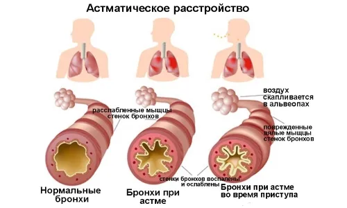 як лікувати алергічну бронхіальну астму