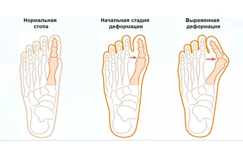 як лікувати бурсит стопи