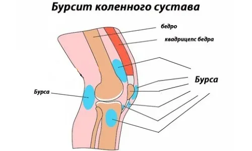 як лікувати бурсит коліна будинку