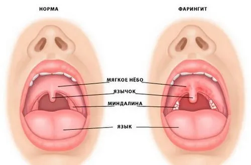 як лікувати атрофічний фарингіт