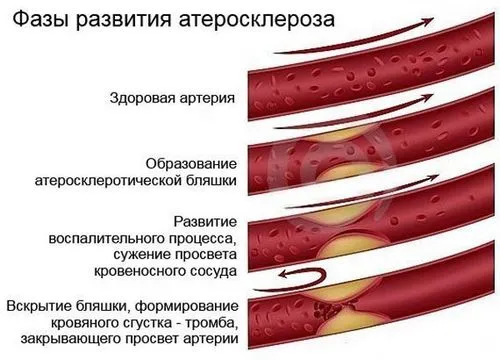 як лікувати судини рук
