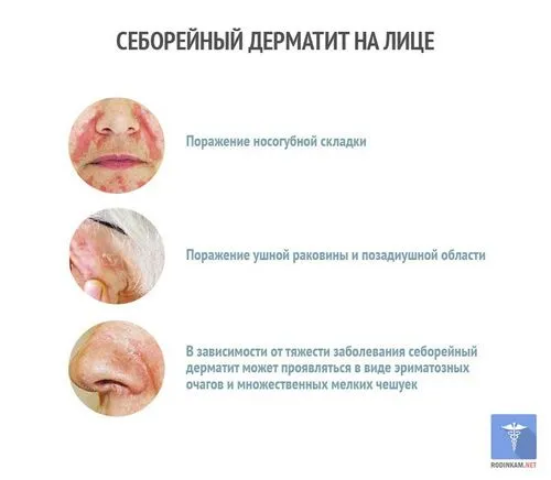 Cеборейний дерматит на обличчі: лікування (симптоми) як лікувати себорейний дерматит особи