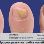 як вилікувати хворий ніготь на нозі