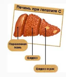 Гепатит с гепатит ц лікується