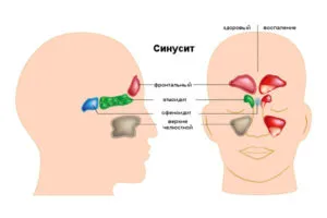 якщо не лікувати риніт