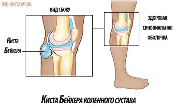 як лікувати кісту Бейкера під коліном