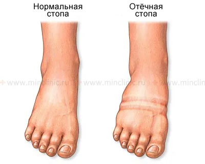 лімфатичний набряк після операції з видалення раку грудей