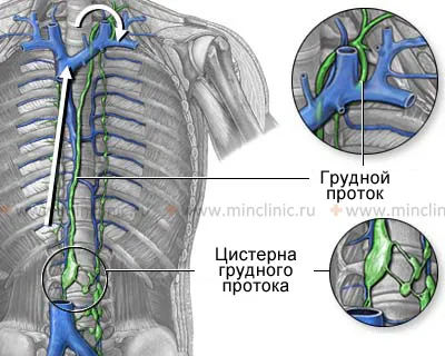 лімфостаз