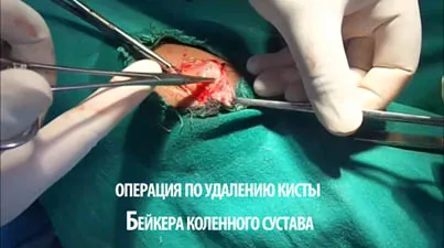 кіста Бейкера колінного суглоба причини лікування видалення