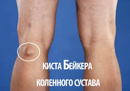 як лікувати кісту Бейкера під коліном