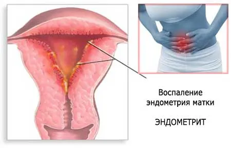 як лікувати хворобу ендометрит