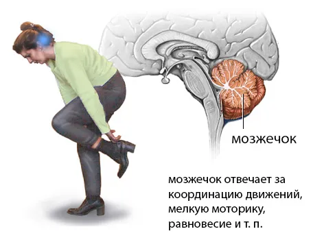 як лікувати інсульт мозочка