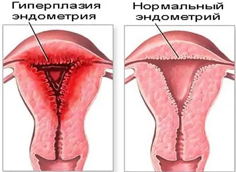 ендометрит що це і як лікувати