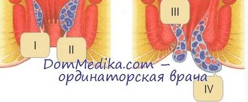 як лікувати геморой