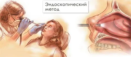 як лікувати грибковий синусит
