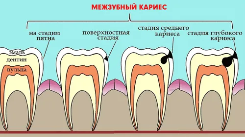 лікувати маленький карієс