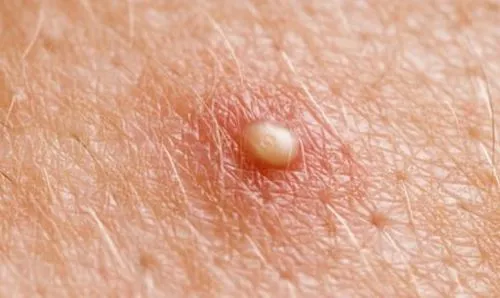 як лікувати фурункул на животі