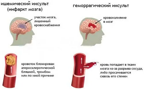 неврологія