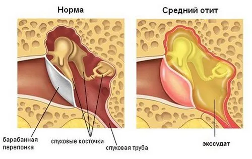 як вилікувати ексудативний отит