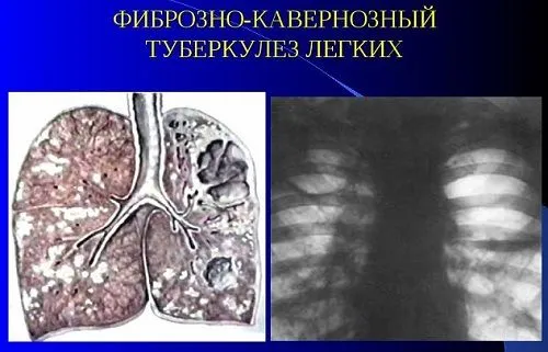 як лікувати кавернознийтуберкульоз