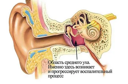 Гнійний отит у дитини: лікування краплі