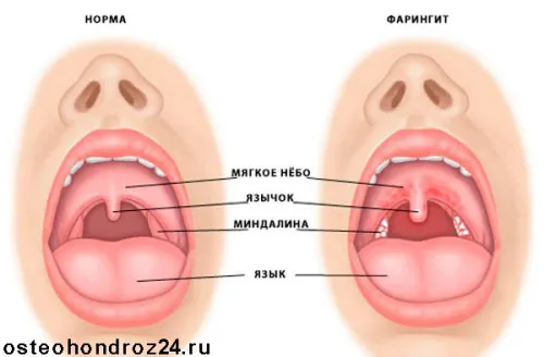 як лікувати гострий фарингіт у дорослих