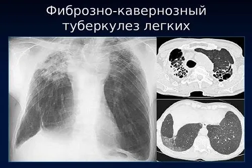 як лікувати кавернознийтуберкульоз