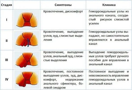 як лікувати геморой 4 стадії