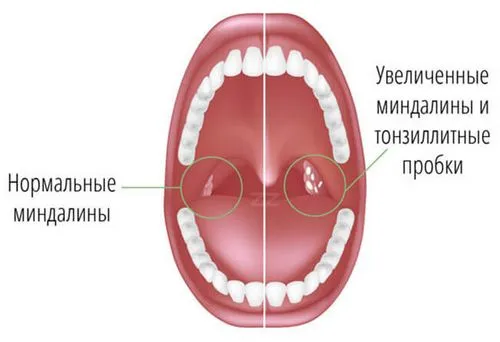 як лікувати мигдалини горла