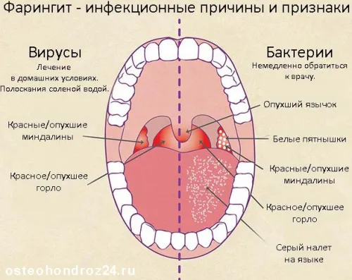 як лікувати гострий фарингіт у дорослих