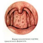 ніж лікувати ларингіт у дитини