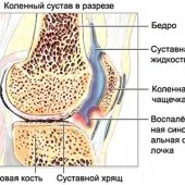 лікування гонартроз колінний артроз суглоб