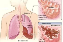 як лікувати часткову пневмонію