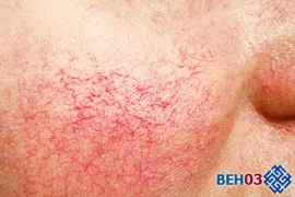 купероз особі фото лікування як лікувати крем особі домашніх умовах особи кошти