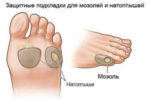 Лікування мозолі на ногах видалення мозолі