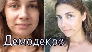 як лікувати кліщ демодекс на віях
