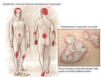 лікувати псоріаз народна медицина