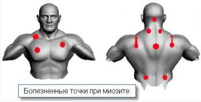 як лікувати міозит шиї в домашніх умовах