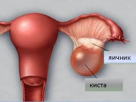 як лікувати кісту яєчника без операції