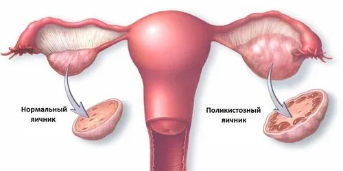 кіста