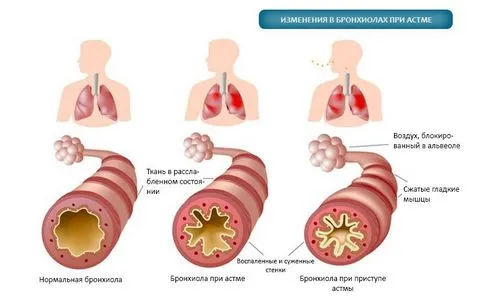 як лікувати астму без ліків