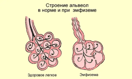 як лікувати астму без ліків