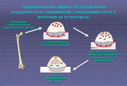 лікування остеопорозу