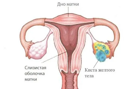 кіста