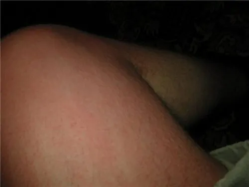 кропив'янка народні методи лікування