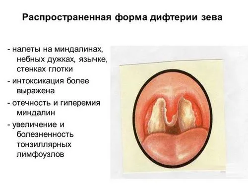 ніж лікувати ларингіт у дитини