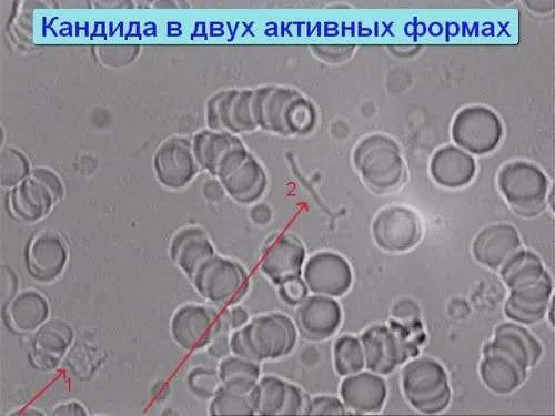 як лікувати кандидоз молочницю