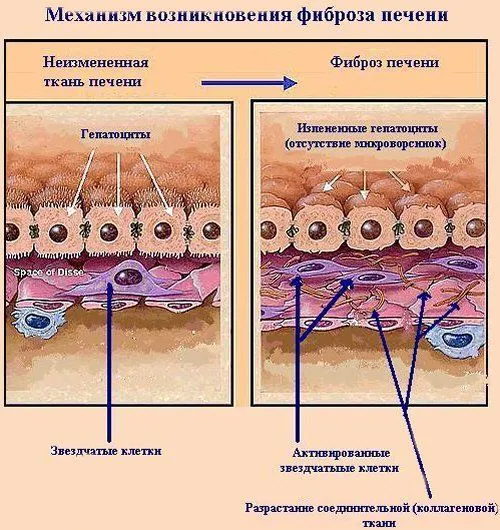 як лікувати фіброз печінки