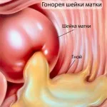 як вилікувати трипер народними засобами