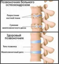 як лікувати остеохондроз на ранній стадії